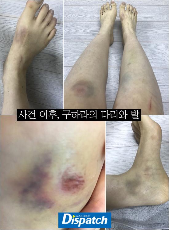 Búp bê xứ Hàn Goo Hara tung bằng chứng bị bạn trai đánh bầm dập vùng kín-3