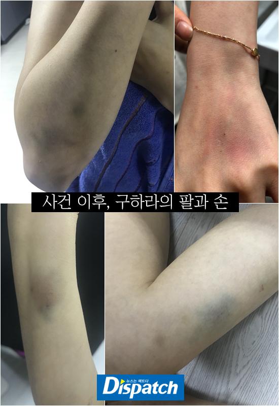 Búp bê xứ Hàn Goo Hara tung bằng chứng bị bạn trai đánh bầm dập vùng kín-4