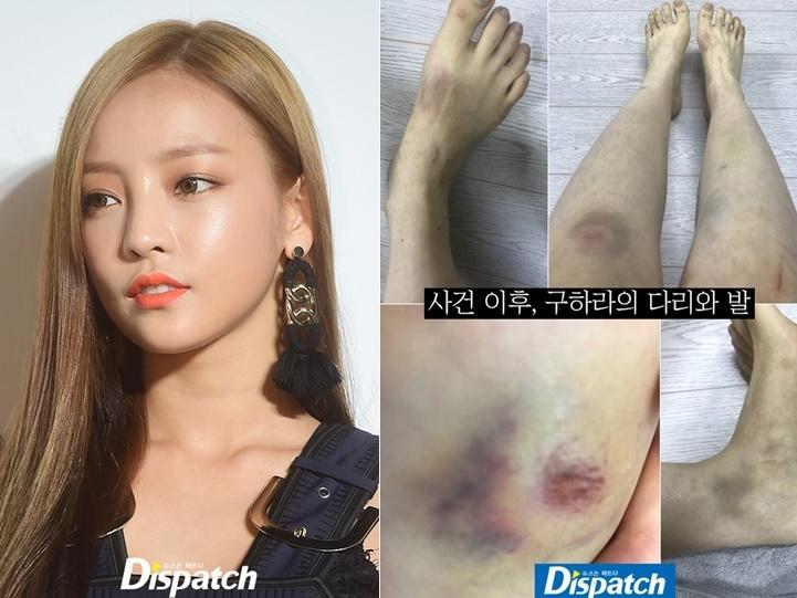 Búp bê xứ Hàn Goo Hara xuất hiện với khuôn mặt đầy thương tích, tay tím bầm vì bị bạn trai bạo hành-12