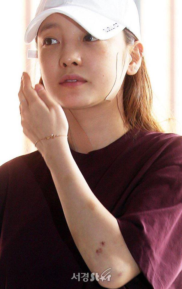Búp bê xứ Hàn Goo Hara xuất hiện với khuôn mặt đầy thương tích, tay tím bầm vì bị bạn trai bạo hành-9