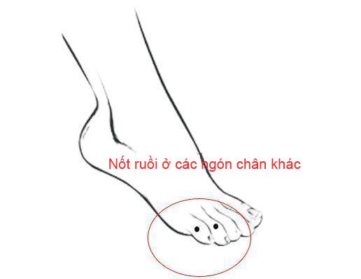 Nốt ruồi trên bàn chân nói lên điều gì?-3