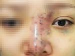 Nữ sinh TP HCM mù mắt khi tiêm filler: Tiết lộ từ bác sĩ điều trị