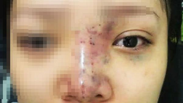 Nữ sinh TP HCM mù mắt khi tiêm filler: Tiết lộ từ bác sĩ điều trị-2