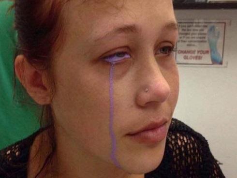 Nữ sinh TP HCM mù mắt khi tiêm filler: Tiết lộ từ bác sĩ điều trị-3