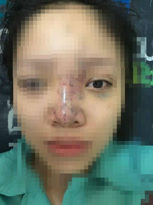 Nữ sinh bị mù mắt khi tiêm filler: Dấu hiệu đáng ngờ bên trong spa-2