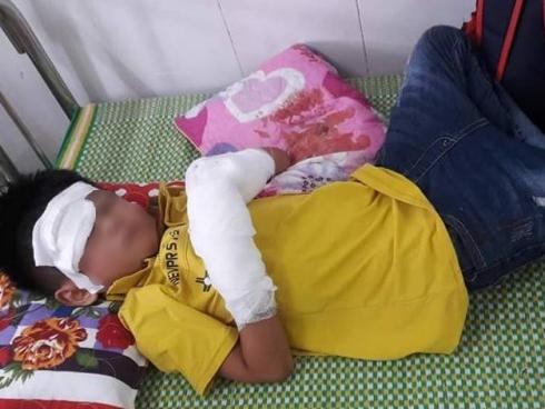 Bé trai dập nát 2 bàn tay vì điện thoại phát nổ