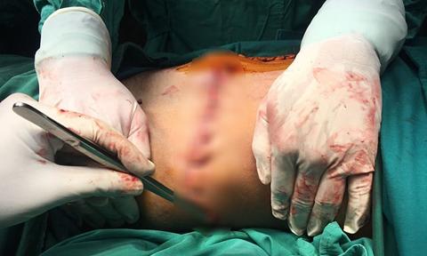 Người đàn ông bị máy cưa cắt đứt bụng, lòi ruột ra ngoài-1