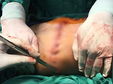 Nam sinh bị bạn cắn đứt tai nuốt vào bụng-3