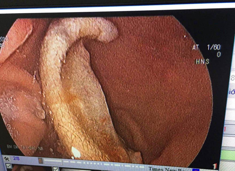 Nam sinh bị bạn cắn đứt tai nuốt vào bụng-1