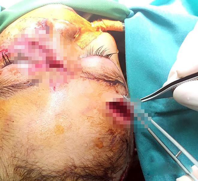 Bé gái 31 tháng tuổi bị chó cắn nát mặt-1