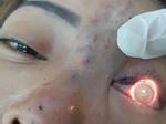 TPHCM: Phạt 120 triệu đồng cơ sở spa tiêm filler nâng mũi khiến bệnh nhân mù mắt