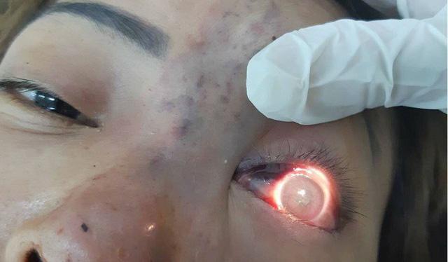 TPHCM: Phạt 120 triệu đồng cơ sở spa tiêm filler nâng mũi khiến bệnh nhân mù mắt-1