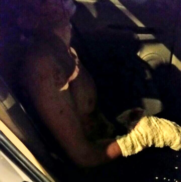 Điện thoại nổ lúc sạc pin, thanh niên bị dập nát bàn tay-1