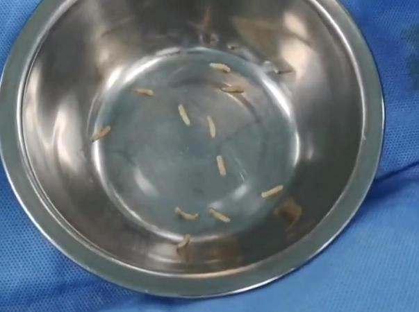 Bắt hơn 50 con giòi từ vết thương mưng mủ của cụ bà 97 tuổi-2