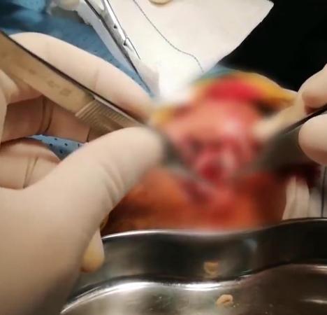 Bắt hơn 50 con giòi từ vết thương mưng mủ của cụ bà 97 tuổi-4