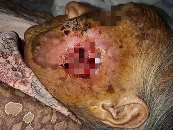 Rùng mình, bác sĩ thả 400 con giòi vào chân để ăn thịt chữa bệnh-3