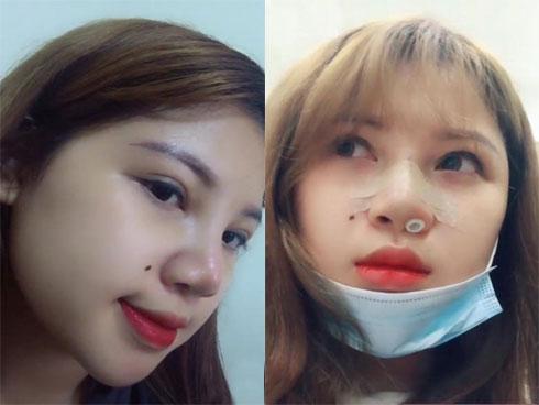 Hút mỡ rồi đến nâng mũi và đây là hình ảnh lột xác choáng váng người nhìn của nữ sinh ngực khủng ở Hải Dương-13