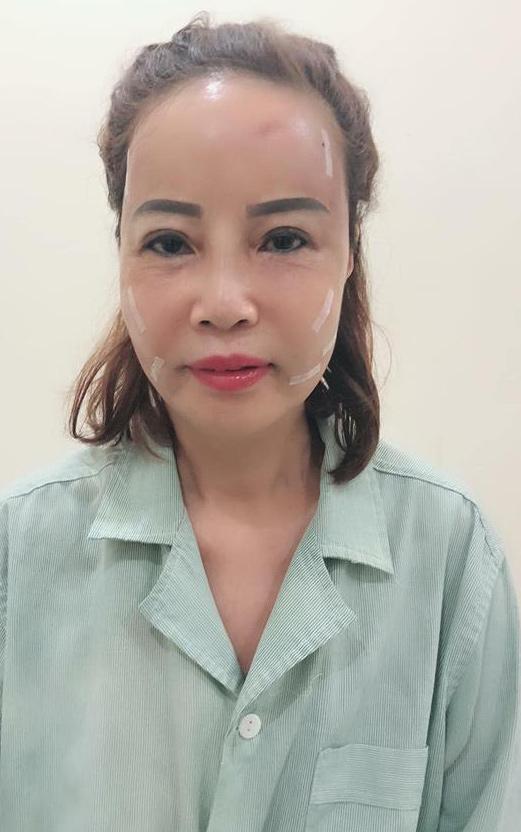 Chịu chơi cấy mỡ tự thân lên mặt, cô dâu 61 tuổi trẻ như 40 khiến chồng 26 vuốt ve mãi không rời-2