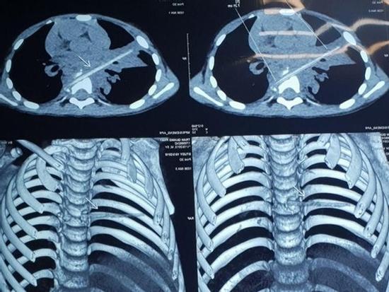 Bé trai bị que xiên thịt đâm xuyên phổi và đốt sống 9 tháng không biết