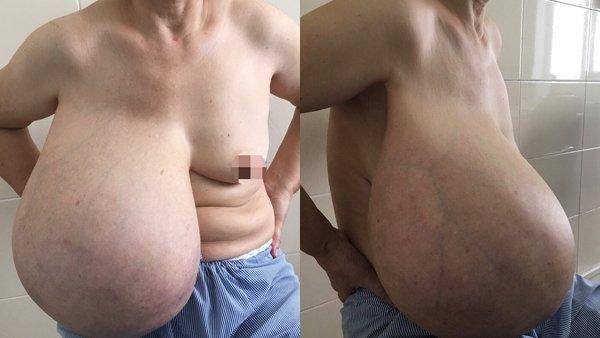 Người phụ nữ lệch người vì ngực dài quá rốn, nặng kỷ lục 9kg-1