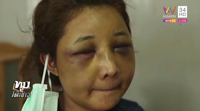 Vợ xinh đẹp bị chồng đánh biến dạng gương mặt chỉ vì để người yêu cũ đưa về nhà khi say rượu-4