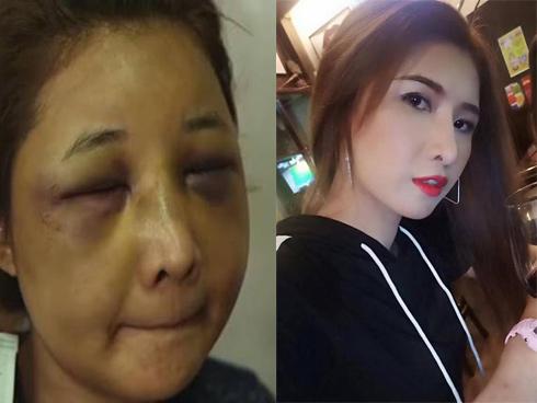 Vợ xinh đẹp bị chồng đánh biến dạng gương mặt chỉ vì để người yêu cũ đưa về nhà khi say rượu