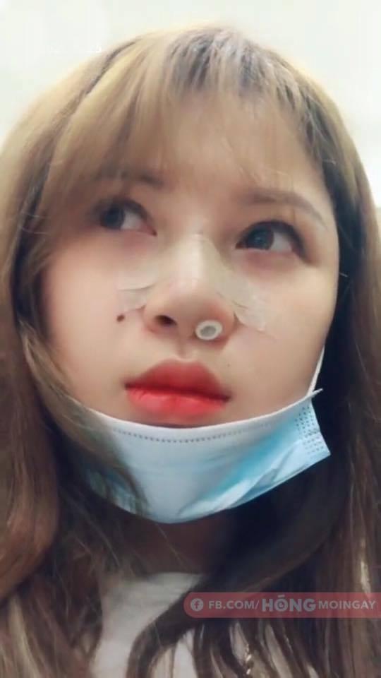 Hút mỡ rồi đến nâng mũi và đây là hình ảnh lột xác choáng váng người nhìn của nữ sinh ngực khủng ở Hải Dương-6