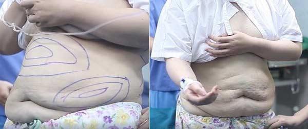 Nàng béo Thủy Tiên và cuộc sống thay đổi sau 2 lần đại phẫu hút mỡ-3