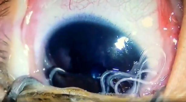 Trung Quốc: Rùng mình cảnh bác sĩ bắt 11 con giun sống từ mắt trẻ sơ sinh-1
