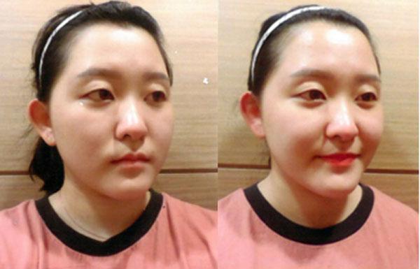 Tạo hình khuôn mặt V-line không dao kéo ở Yakson Beauty Spa-3