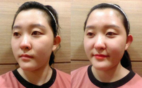 Tạo hình khuôn mặt V-line không dao kéo ở Yakson Beauty Spa-4