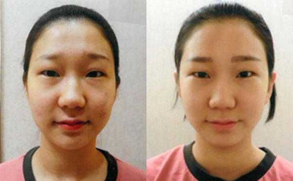 Tạo hình khuôn mặt V-line không dao kéo ở Yakson Beauty Spa-5