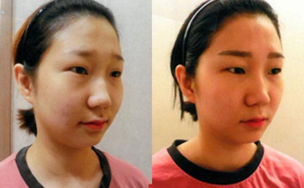 Tạo hình khuôn mặt V-line không dao kéo ở Yakson Beauty Spa-6