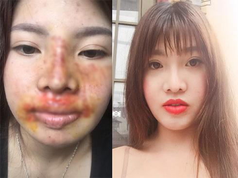 Khoe mặt hết sạch vết bầm tím vì ngã xe nhưng dân mạng chỉ quan tâm hàm răng trắng sứ của Thị Nở tái sinh Quách Phượng-6