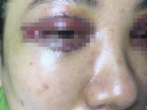 Cô gái trẻ tố chủ thẩm mỹ dùng keo gắn móng tay để nối mi hại cô sưng vù mắt và còn suýt bị mù-4