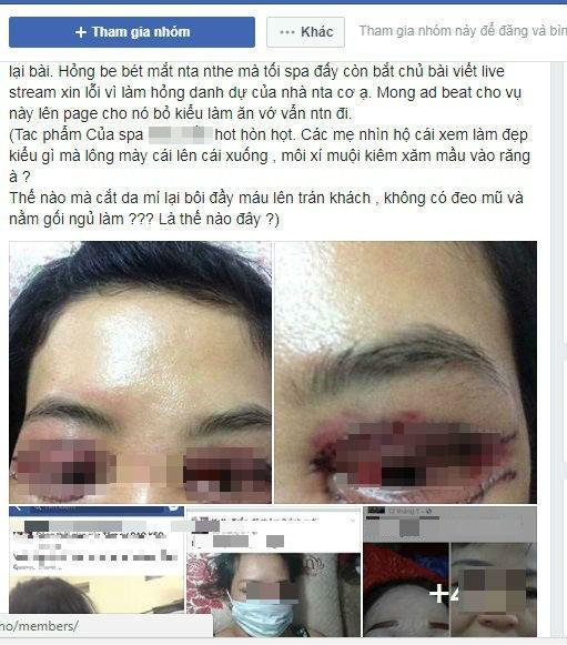 Cô gái trẻ tố chủ thẩm mỹ dùng keo gắn móng tay để nối mi hại cô sưng vù mắt và còn suýt bị mù-3
