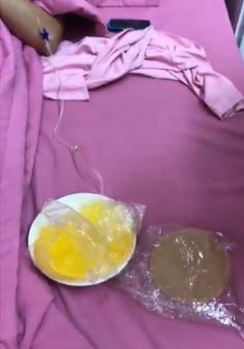 Sốc với cảnh cô gái trẻ bất ngờ bị nổ túi ngực 2.000 USD ngay trên máy bay-2