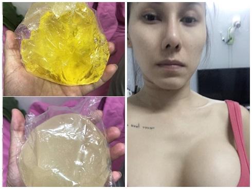 Ca sĩ vỡ túi nâng ngực trên máy bay: Tôi đau như sống trong địa ngục-2