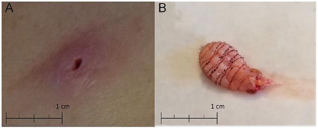 Mỹ: Phát hiện dòi ăn thịt làm tổ trong chân vì bị côn trùng cắn-1