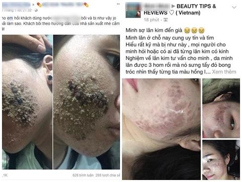 Góc cảnh báo: Cứ thích lăn kim, lột da nữa đi, bạn sẽ 'mất mặt' như chơi đó!