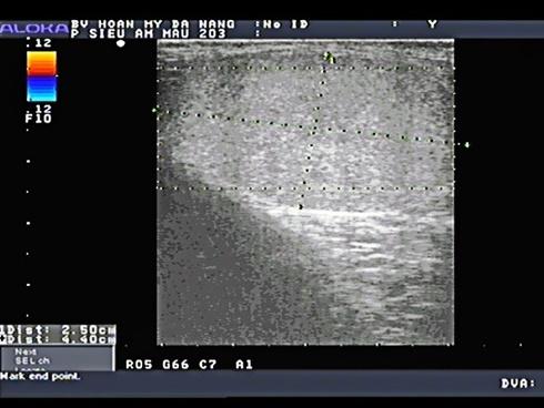 Em bé 1 tuổi mang cặp sừng quỷ dữ sau ca phẫu thuật bất thành-4