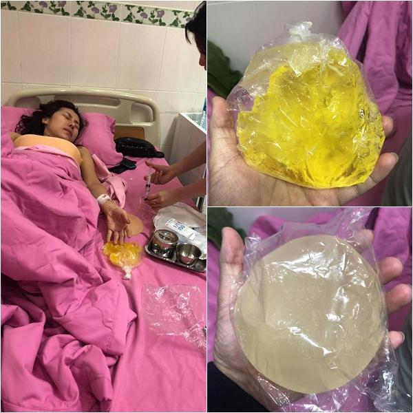 Đau như sống trong địa ngục nhưng ca sĩ bị nổ túi ngực Ivy Trần một mực không đến bệnh viện vì kinh tế kiệt quệ-1