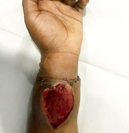 Clip: Người đàn ông đứt lìa bàn tay do ngã vào máy cưa lúc bị bò truy đuổi-2