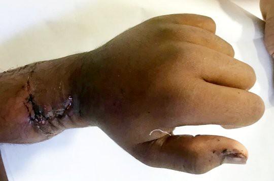 Clip: Người đàn ông đứt lìa bàn tay do ngã vào máy cưa lúc bị bò truy đuổi-3