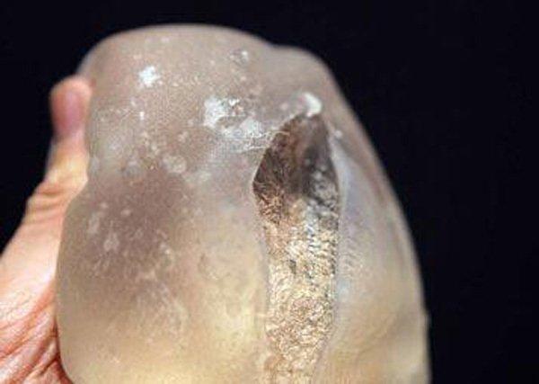 Người mẹ 28 tuổi bị nổ túi ngực 170 triệu đồng khi cho con bú-2