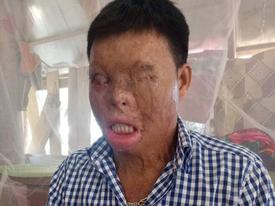 Cuộc sống khốn khổ của chàng trai có khuôn mặt biến dạng vì bị tạt axit nhầm Cuộc sống khốn khổ của chàng trai có khuôn mặt biến dạng vì bị tạt axit nhầm