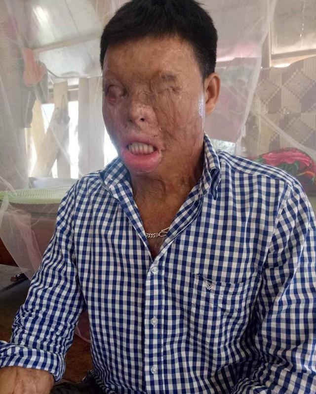 Cuộc sống khốn khổ của chàng trai có khuôn mặt biến dạng vì bị tạt axit nhầm-1