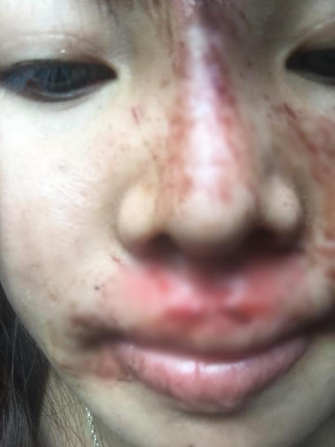 Khoe mặt hết sạch vết bầm tím vì ngã xe nhưng dân mạng chỉ quan tâm hàm răng trắng sứ của Thị Nở tái sinh Quách Phượng-1