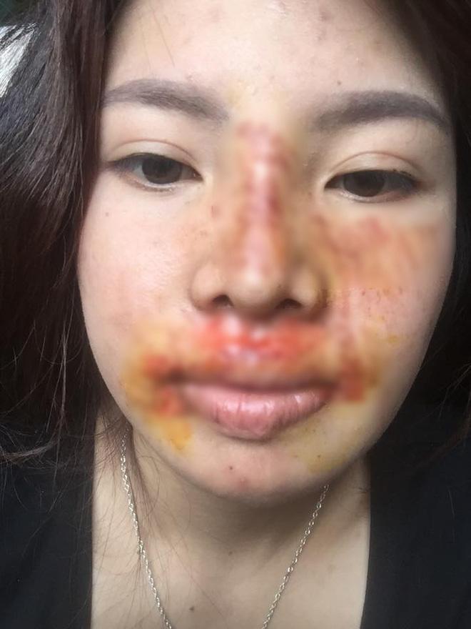 Khoe mặt hết sạch vết bầm tím vì ngã xe nhưng dân mạng chỉ quan tâm hàm răng trắng sứ của Thị Nở tái sinh Quách Phượng-2