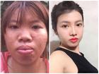 8 ca thẩm mỹ của chị em Việt gây bão dư luận vì biến 'gái xấu thành tiên'